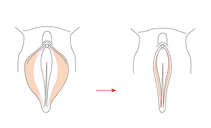 Vaginal Rejuvenation in Ghana: Understanding the Options and Benefits