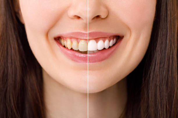 Whitening Wonders: Cutting-Edge Teeth Whitening in Riyadh